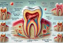 How Long Until a Tooth Infection Kills You