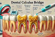 calculus bridge