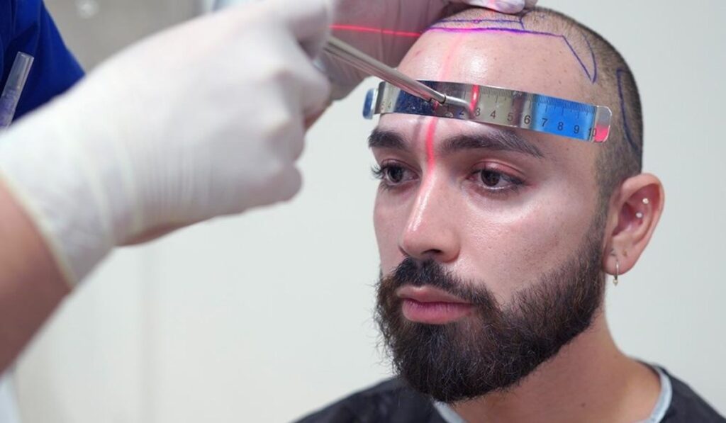Hermest Is the Best Hair Transplant