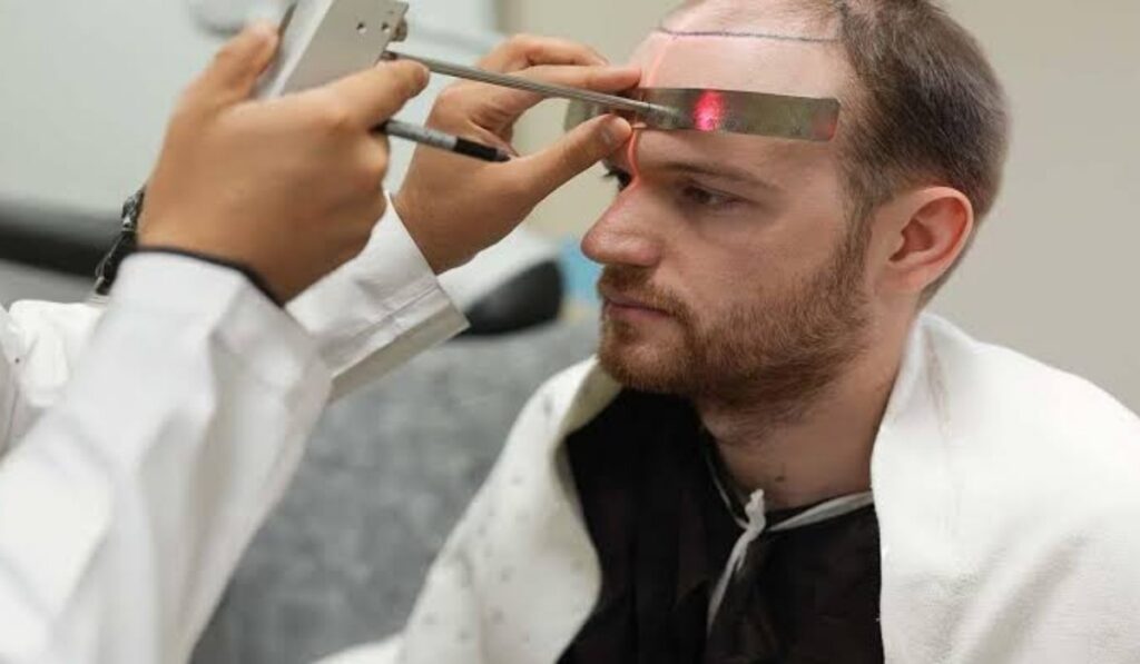 Hermest Is the Best Hair Transplant