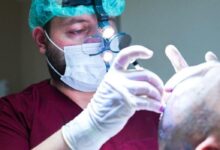 Hermest Is the Best Hair Transplant