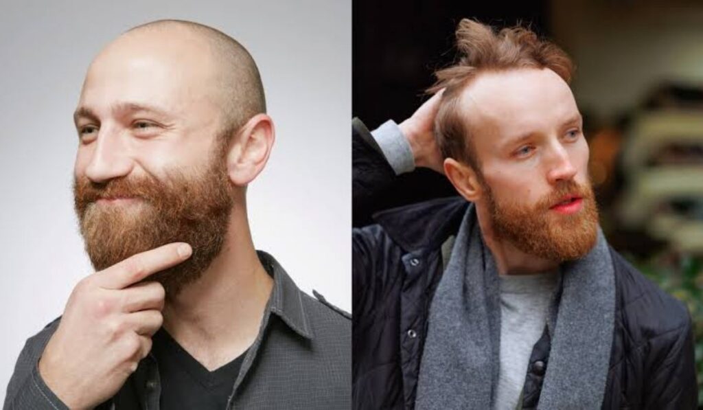 Managing Hair Loss