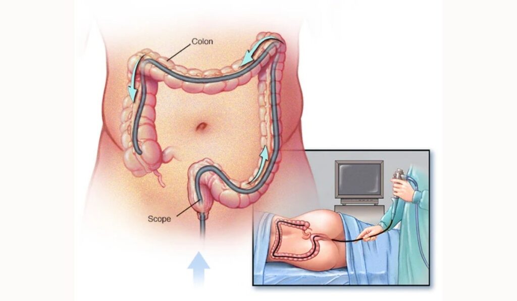 Right Colonoscopy