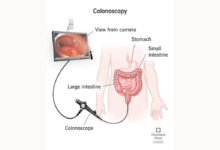 Right Colonoscopy