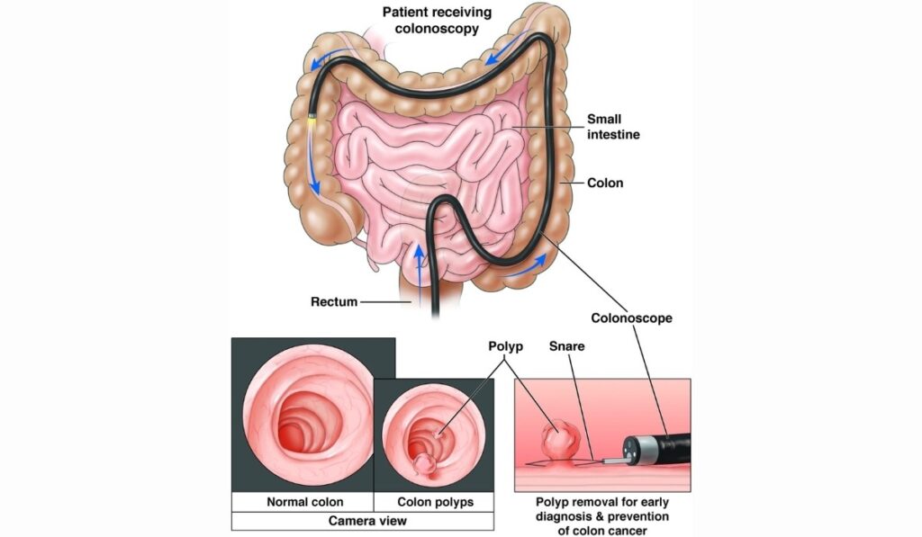 Right Colonoscopy